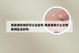 银屑病生物药可以治愈吗 银屑病用什么生物制剂能治好吗