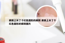 肩膀上长了个红色圆形的癣斑 肩膀上长了个红色圆形的癣斑图片