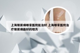 上海银屑病哪家医院能治好 上海哪家医院治疗银屑病最好的地方