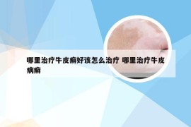 哪里治疗牛皮癣好该怎么治疗 哪里治疗牛皮病癣