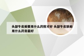 头部牛皮癣要用什么药擦才好 头部牛皮肤癣用什么药膏最好