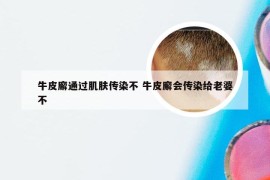 牛皮廨通过肌肤传染不 牛皮廨会传染给老婆不