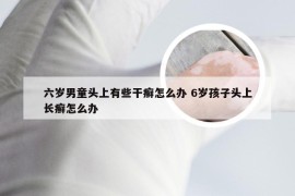 六岁男童头上有些干癣怎么办 6岁孩子头上长癣怎么办