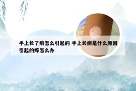 手上长了癣怎么引起的 手上长癣是什么原因引起的痒怎么办