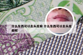 什么东西可以去头皮癣 什么东西可以去头皮癣呢