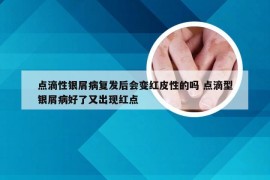 点滴性银屑病复发后会变红皮性的吗 点滴型银屑病好了又出现红点