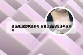 西医能治愈牛皮癣吗 有什么西药能治牛皮廨吗