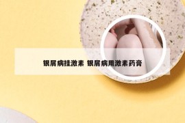 银屑病挂激素 银屑病用激素药膏