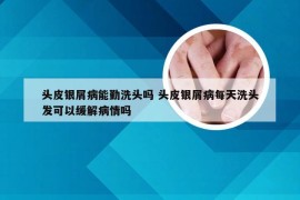 头皮银屑病能勤洗头吗 头皮银屑病每天洗头发可以缓解病情吗