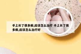 手上长了很多癣,应该怎么治疗 手上长了很多癣,应该怎么治疗好