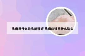 头癣用什么洗头能洗好 头癣应该用什么洗头