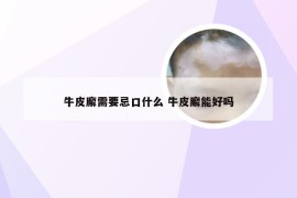 牛皮廨需要忌口什么 牛皮廨能好吗