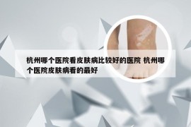 杭州哪个医院看皮肤病比较好的医院 杭州哪个医院皮肤病看的最好