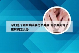 孕妇患了银屑病该要怎么办呢 怀孕期间得了银屑病怎么办