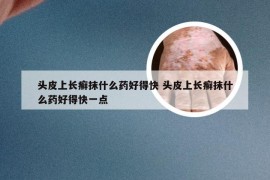 头皮上长癣抹什么药好得快 头皮上长癣抹什么药好得快一点