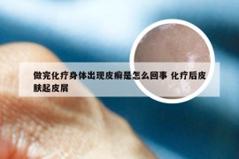 做完化疗身体出现皮癣是怎么回事 化疗后皮肤起皮屑