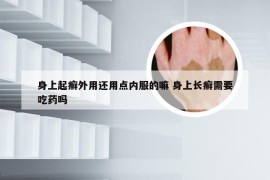 身上起癣外用还用点内服的嘛 身上长癣需要吃药吗