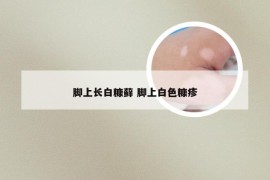 脚上长白糠藓 脚上白色糠疹