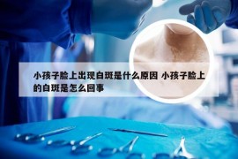 小孩子脸上出现白斑是什么原因 小孩子脸上的白斑是怎么回事