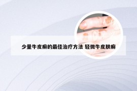 少量牛皮癣的最佳治疗方法 轻微牛皮肤癣