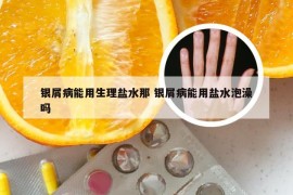 银屑病能用生理盐水那 银屑病能用盐水泡澡吗