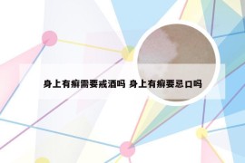 身上有癣需要戒酒吗 身上有癣要忌口吗