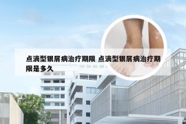 点滴型银屑病治疗期限 点滴型银屑病治疗期限是多久