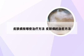 皮肤病有哪些治疗方法 皮肤病的治愈方法