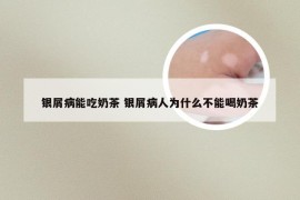 银屑病能吃奶茶 银屑病人为什么不能喝奶茶