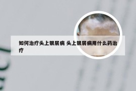 如何治疗头上银屑病 头上银屑病用什么药治疗