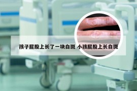 孩子屁股上长了一块白斑 小孩屁股上长白斑