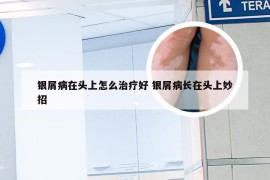 银屑病在头上怎么治疗好 银屑病长在头上妙招