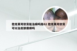 他克莫司软膏能治癣吗路82 他克莫司软膏可以治皮肤瘙痒吗