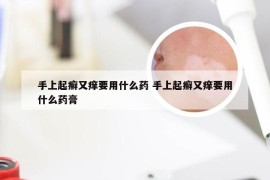 手上起癣又痒要用什么药 手上起癣又痒要用什么药膏