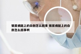 银屑病腿上的白削怎么回事 银屑病腿上的白削怎么回事啊