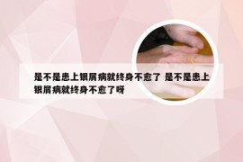 是不是患上银屑病就终身不愈了 是不是患上银屑病就终身不愈了呀