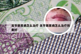 关节银屑病怎么治疗 关节银屑病怎么治疗效果好