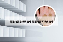 醋泡鸡蛋治银屑病吗 醋泡鸡蛋可以去疣吗