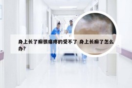 身上长了癣很痛疼的受不了 身上长癣了怎么办?