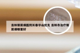 吉林银屑病医院长春华山优先 吉林市治疗银屑病哪里好