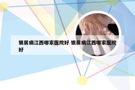 银屑病江西哪家医院好 银屑病江西哪家医院好