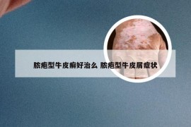 脓疱型牛皮癣好治么 脓疱型牛皮屑症状