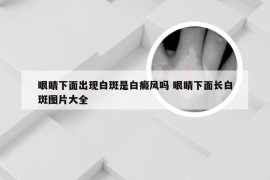 眼睛下面出现白斑是白癜风吗 眼睛下面长白斑图片大全