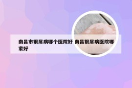 南昌市银屑病哪个医院好 南昌银屑病医院哪家好