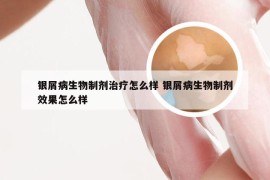 银屑病生物制剂治疗怎么样 银屑病生物制剂效果怎么样