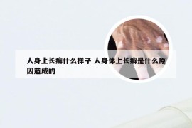 人身上长癣什么样子 人身体上长癣是什么原因造成的