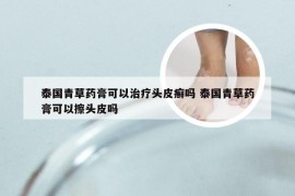 泰国青草药膏可以治疗头皮癣吗 泰国青草药膏可以擦头皮吗