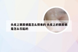 头皮上银屑病是怎么得来的 头皮上的银屑病是怎么引起的