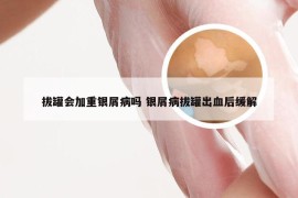 拔罐会加重银屑病吗 银屑病拔罐出血后缓解