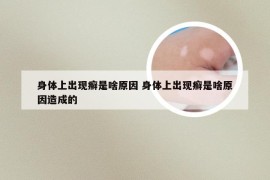 身体上出现癣是啥原因 身体上出现癣是啥原因造成的